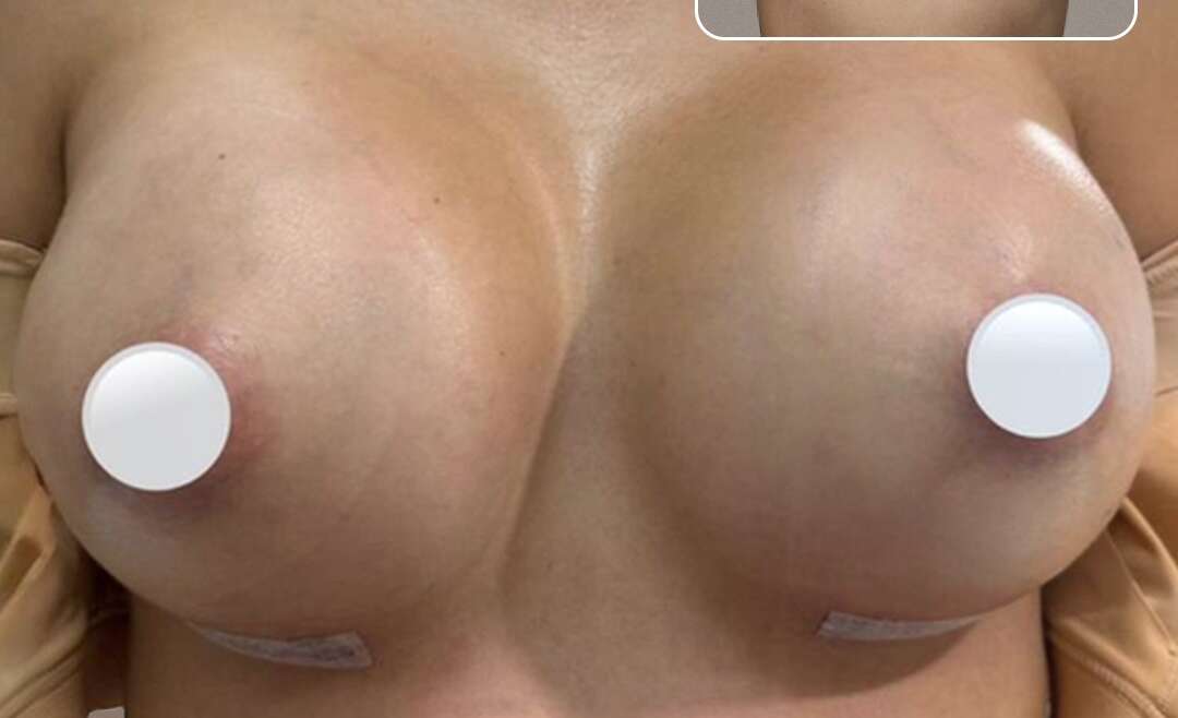 Breast Augmentation